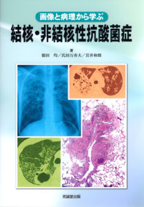 結核・非結核性抗酸菌症